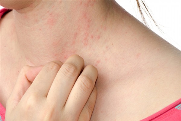 İsilik nedir? İsilik neden olur? İsilik nasıl geçer?